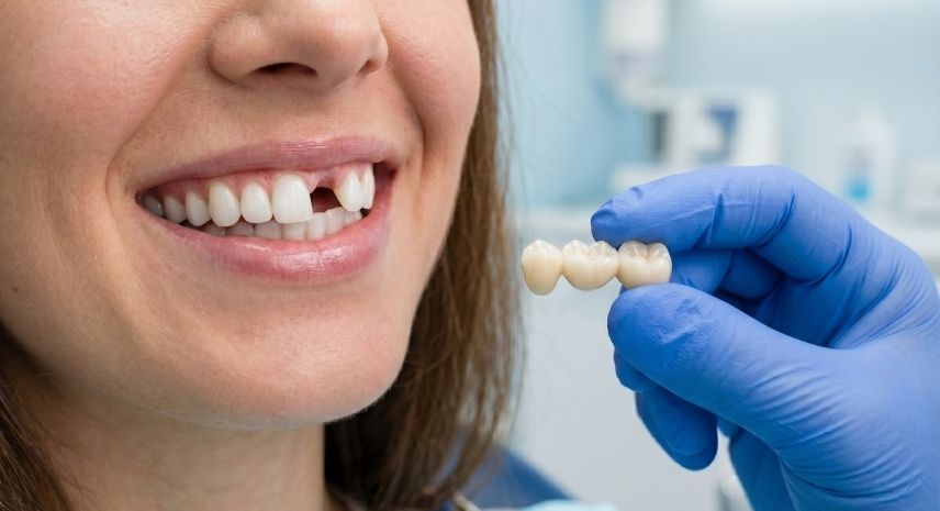 Dental Crowns Bridges 