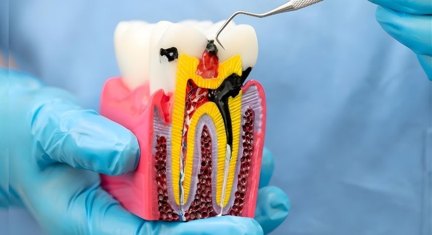 Root Canal Treatment Sangli