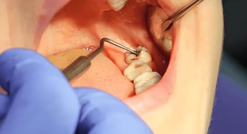 Wisdom Tooth Removal Sangli